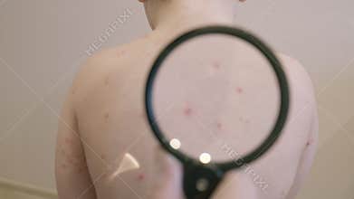 A closeup view of a specific skin condition chickenpox, carefully examined through a magnifying glass