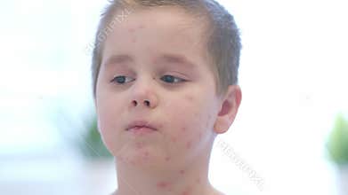 A child with a skin condition chickenpox being photographed in a bright and cheerful environment