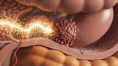 Detailed 3D CGI Medical Animation Illustrating Intestinal Polyp Growth and Digestive Processes with Pulsating Energy and Blood