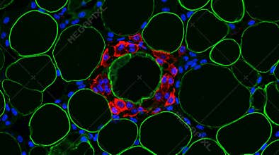 Adipose Tissue Macrophage Crown-Like Structure