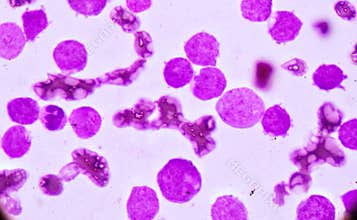 Blood smear under microscopy showing on Adult acute myeloid leukemia AML is a type of cancer in which the bone marrow makes abn