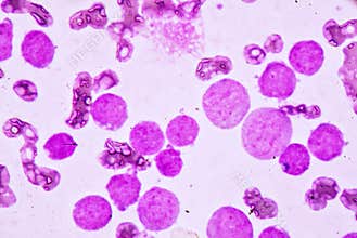 JBlood smear under microscopy showing on Adult acute myeloid leukemia AML is a type of cancer in which the bone marrow makes abn