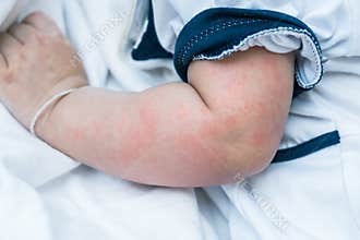 Baby skin texture suffering severe urticaria, nettle rash.