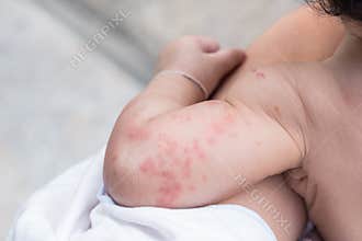 Baby skin texture suffering severe urticaria, nettle rash.