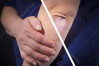 Psoriasis on elbow before and after