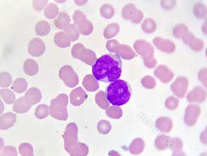 Leukemia cells