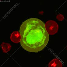 Cancer cells and killer
