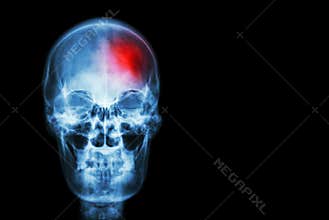 Stroke ( Cerebrovascular accident ) . film x-ray skull of human with red area ( Medical , Science and Healthcare concept and backg