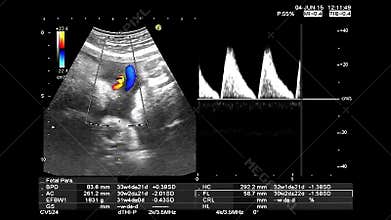 Ultrasound echography gynecological medical examination. Fetus heartbeat recording and thermal analysis