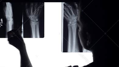 Doctor analyse x rays broken bones.