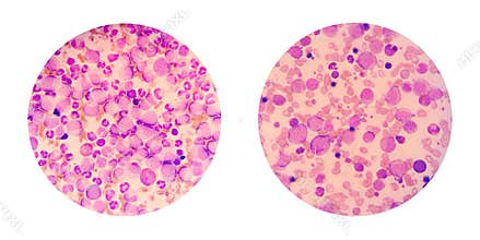 Microscopic views of a blood smear from leukemia patient show ma