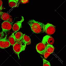 Real fluorescence microscopic view of human neuroblastoma cells