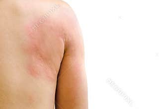 Urticaria - isolated on white background with clipping path.
