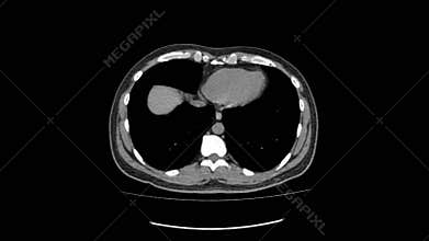 Ct scan of upper abdomen top view