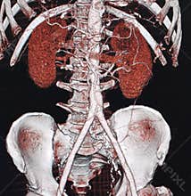 ABDOMINAL AORTIC ANEURYSM, CT