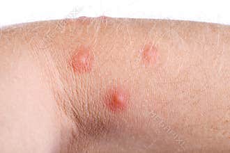 Pimples on skin