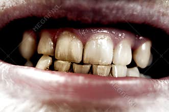 Aggressive teeth