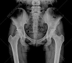 Hip Bone Xray, Human Body