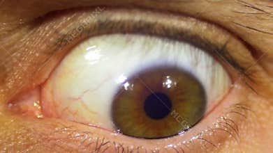 Crazy Eye Rotation Of The Eyeball