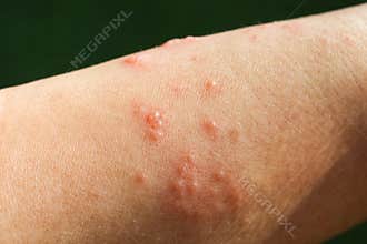 Skin rash as allergic symptoms due to arm fiberglass cast