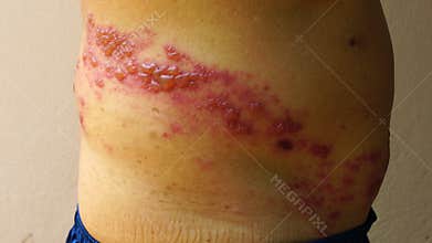 Skin lesion symptom in Shingles or Herpes zoster in human.