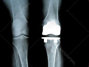 Titanium Knee