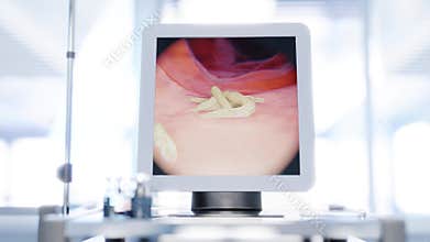 Exploration using gastroscope equipment - film showcasing visualization of bacteria detection during examination
