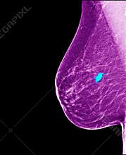 Breast cancer - mammogram