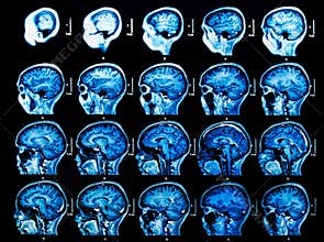 MRI Brain Scan