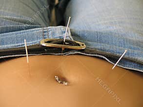 Acupuncture