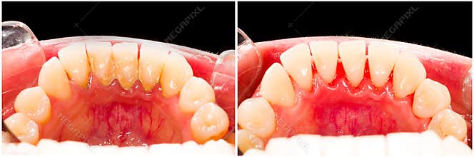 Plaque Removal