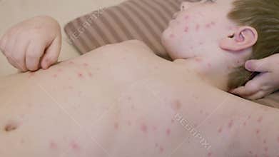 A child with a skin condition is showing red spots chickenpox all over their back area, which is concerning