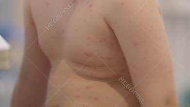 A childs skin condition chickenpox featuring pink bumps and rashes needs proper care and attention