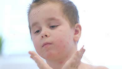Child with Acne A Comprehensive Guide to Understanding Skin Conditions chickenpox in Youthful Individuals