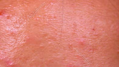 Close up of Acne skin because the disorders Of