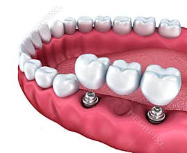 A close-up view of lower teeth and dental implants