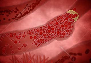 Clogged Artery with platelets and cholesterol plaque, concept for health risk for obesity or dieting and nutrition problems