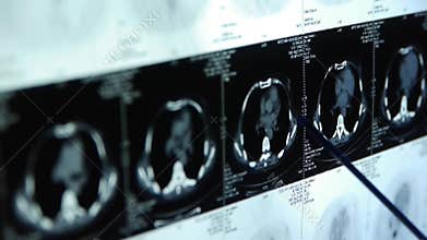 Doctor study Breast pet-ct scan,medical x-ray.