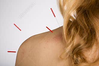 Acupuncture patient