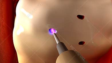 Laparoscopic Ovarian Drilling