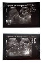 Abdominal pelvic sonography