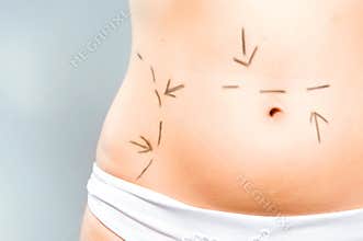 Marks on abdomen for surgery