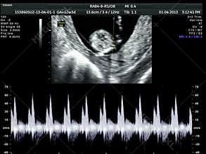 Baby ultrasound scan