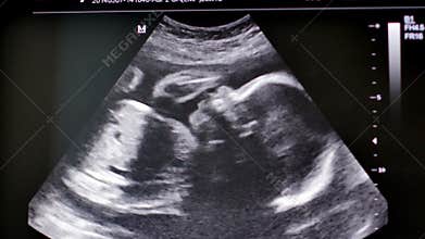 Monitor with medical ultrasound scan of human baby. 4K UltraHD video