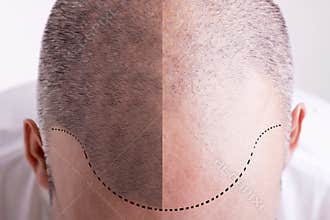Hair Loss - Before and After