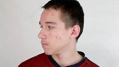 Puberty acne problem