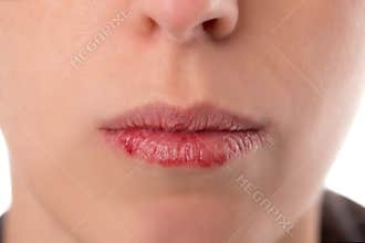 Closeup woman´s face with brittle and dry lips, concept lip sal