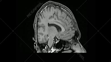 MRI Brain 3D Rotation
