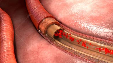 Blood Flow in vessels