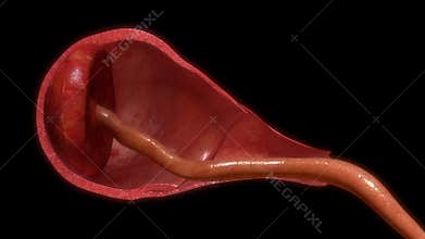 Pulling placenta out of uterus